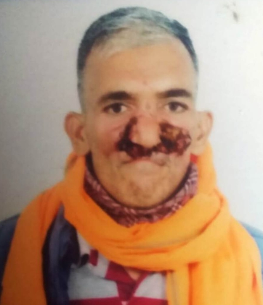 मुंह के कैंसर से पीड़ित गरीब को मदद की दरकार